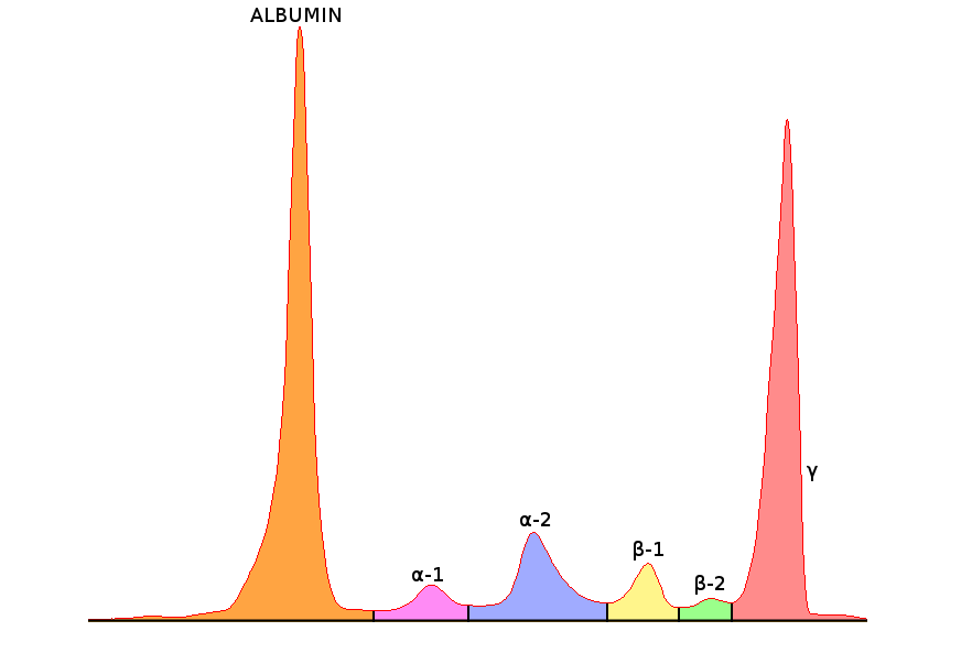 Interpreting Serum Protein Electrophoresis Spe Patterns Bcit News 